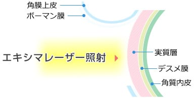 エキシマレーザー照射 詳細図