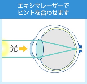 エキシマレーザーで ピントを合わせます