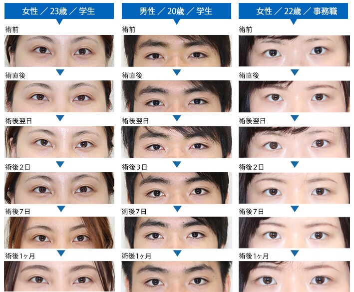 ICL(眼内コンタクトレンズ)症例写真