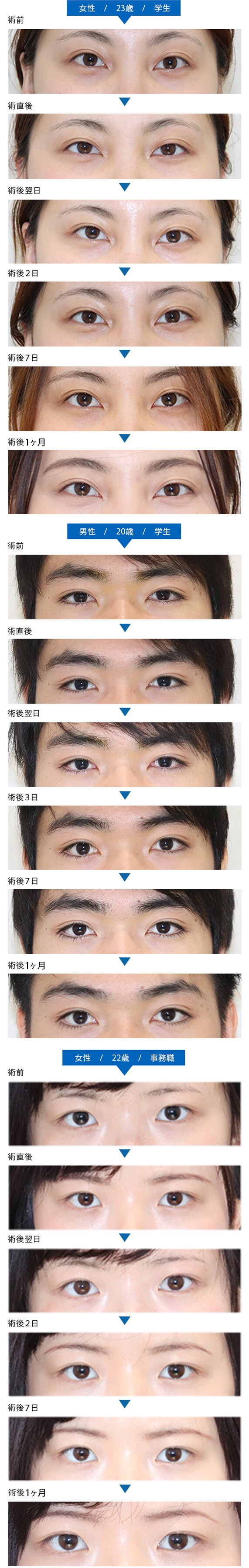 ICL(眼内コンタクトレンズ)症例写真