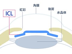 ICL（眼内コンタクトレンズ）の装着イメージ