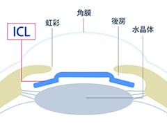 ICL（眼内コンタクトレンズ）の装着イメージ