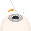 STEP4 角膜上皮をめくる