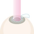 STEP5 角膜を矯正する