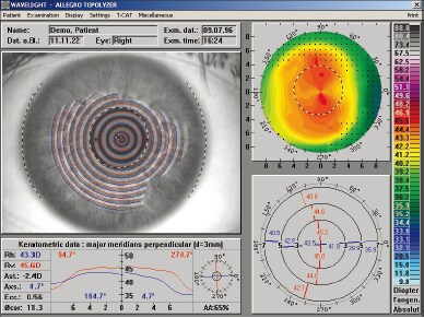 手術時の眼球の回旋（傾き）を測定