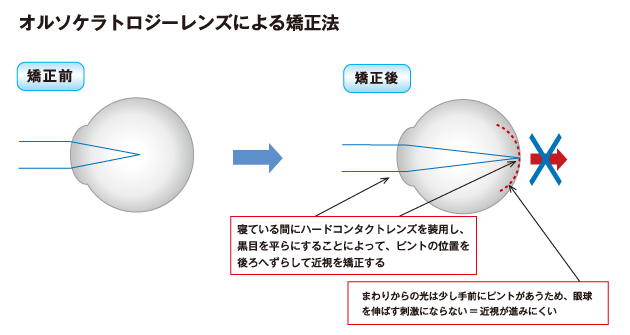近視が進行する仕組み
