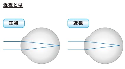 近視が進行する仕組み
