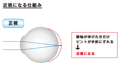 近視が進行する仕組み