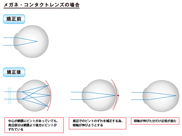 近視が進行する仕組み