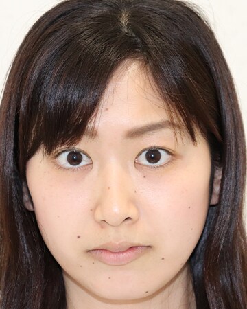 Icl 眼内コンタクトレンズ 症例 女性 27歳 会社員 レーシックの 新宿近視クリニック Icl 眼内コンタクトレンズ 症例 女性 27歳 会社員 レーシックの 新宿近視クリニック