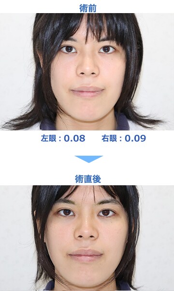Icl 眼内コンタクトレンズ 症例 女性 27歳 Se レーシックの 新宿近視クリニック