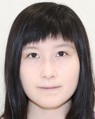 Icl 眼内コンタクトレンズ 症例 女性 26歳 自営業 レーシックの 新宿近視クリニック Icl 眼内コンタクトレンズ 症例 女性 26歳 自営業 レーシックの 新宿近視クリニック