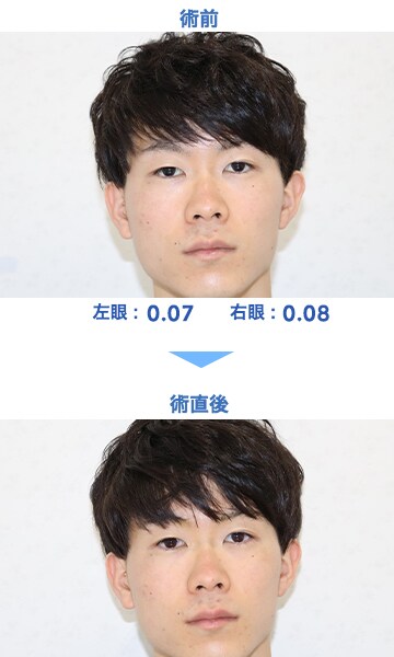 Icl 眼内コンタクトレンズ 症例 男性 25歳 会社員 レーシックの 新宿近視クリニック