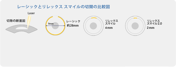 レーシックとリレックス スマイルの切開の比較図